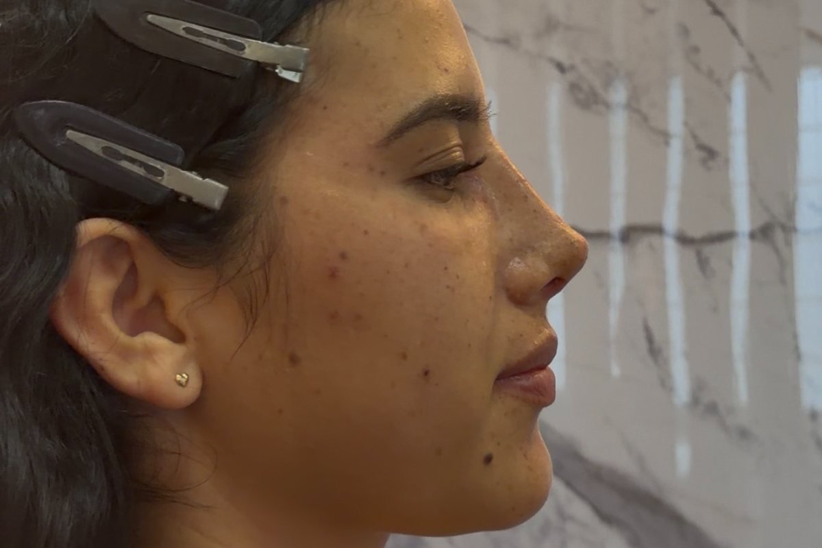 Perfil facial — rinoplastia
